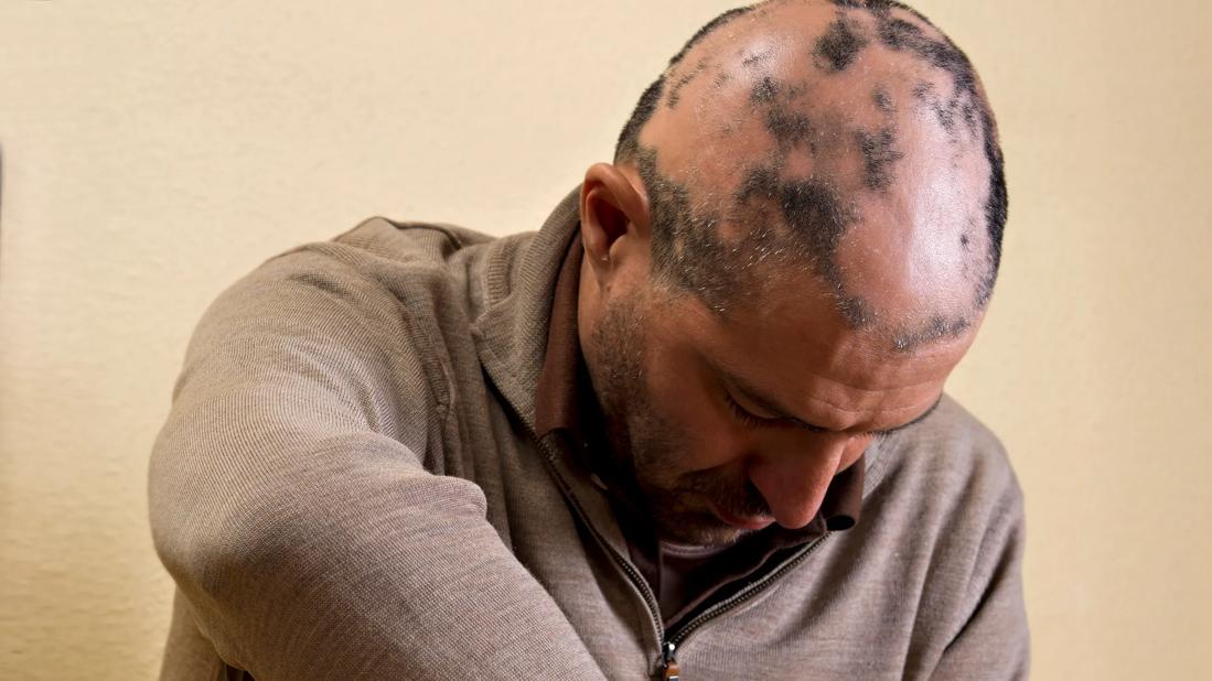 A person bends their head forward to show extensive patches of hair loss