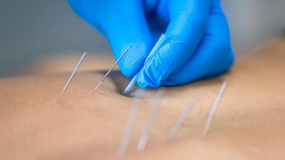 Close up of hand in blue gloves inserting dry needling into muscles