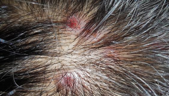 Scabs on a scalp with hair