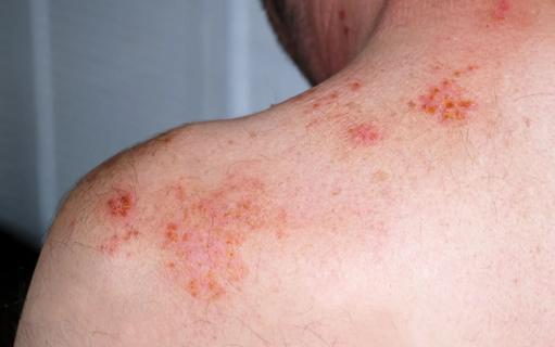 Shingles outbreak on shoulders