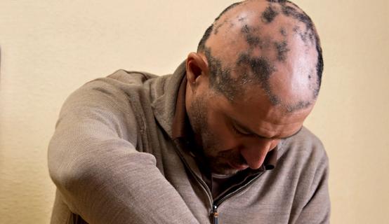 A person bends their head forward to show extensive patches of hair loss